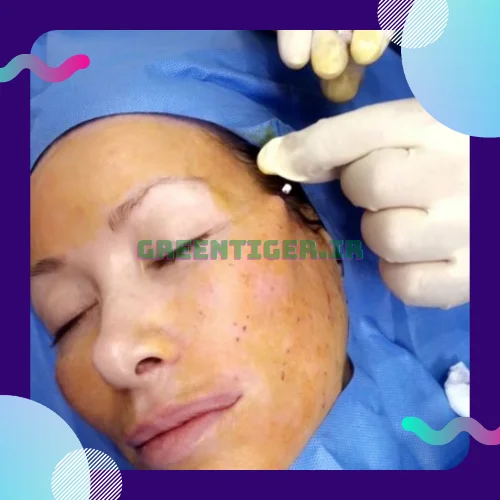 لیفت شقیقه با نخ نی نی سایت