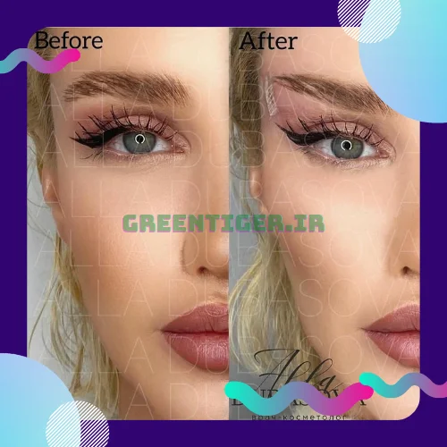 قیمت لیفت شقیقه با نخ