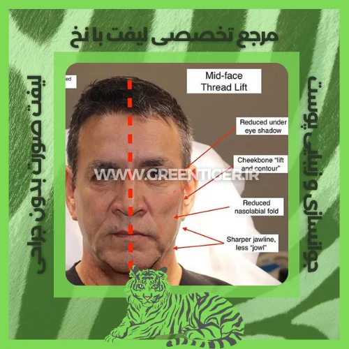 زاویه سازی صورت با نخ نی نی سایت