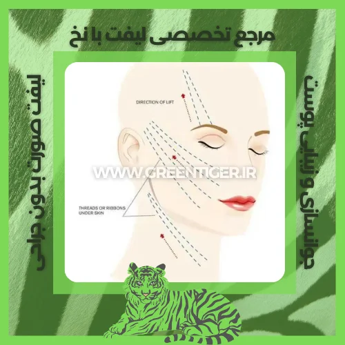 جوانسازی صورت با نخ